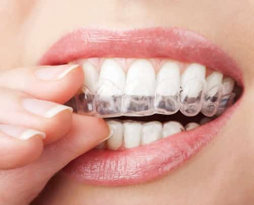 Invisalign system