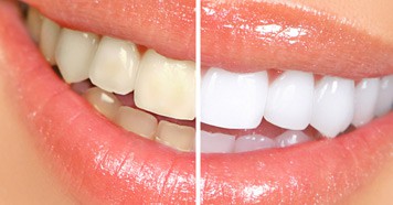 Professional Teeth Whitening