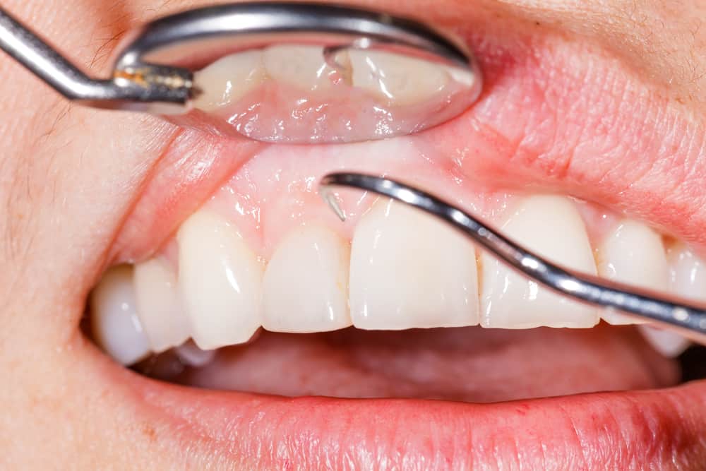 Gum Disease Prevention