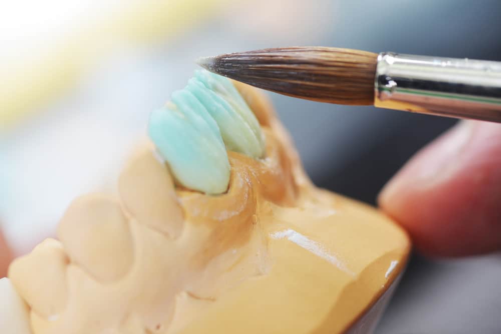 veneers