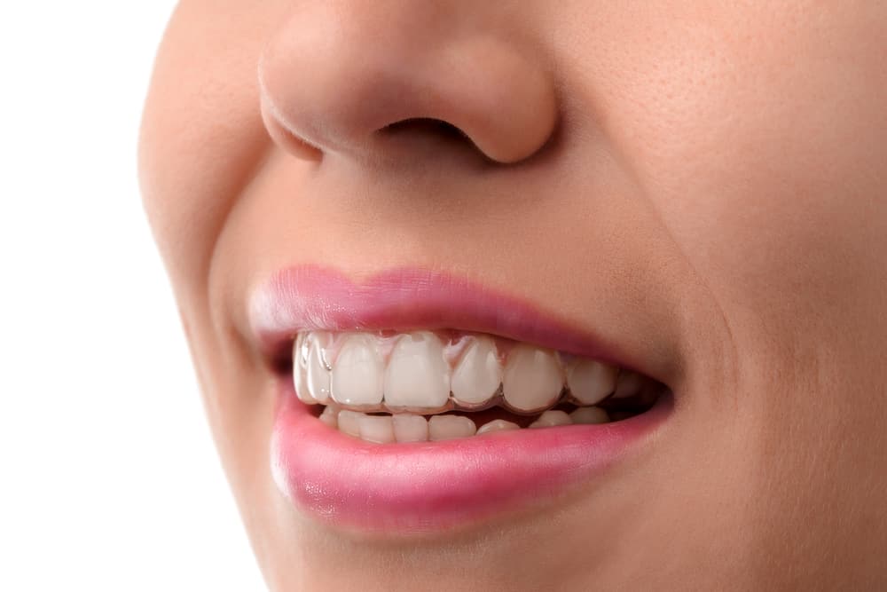 Invisalign aligners