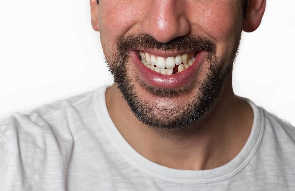 Missing Teeth Replacement